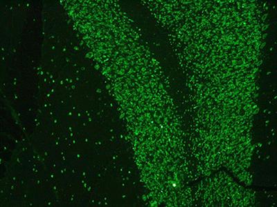 MSA Mimic? Rare Occurrence of Anti-Hu Autonomic Failure and Thymoma in a Patient with Parkinsonism: Case Report and Literature Review